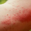 How To Treat Bug Bites and Stings