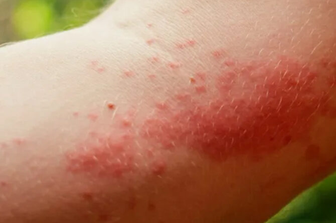 How To Treat Bug Bites and Stings