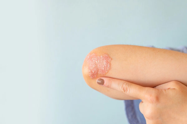 What is Ringworm: Symptoms and Treatment