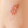 Facts About Shingles: Is Shingles Contagious?